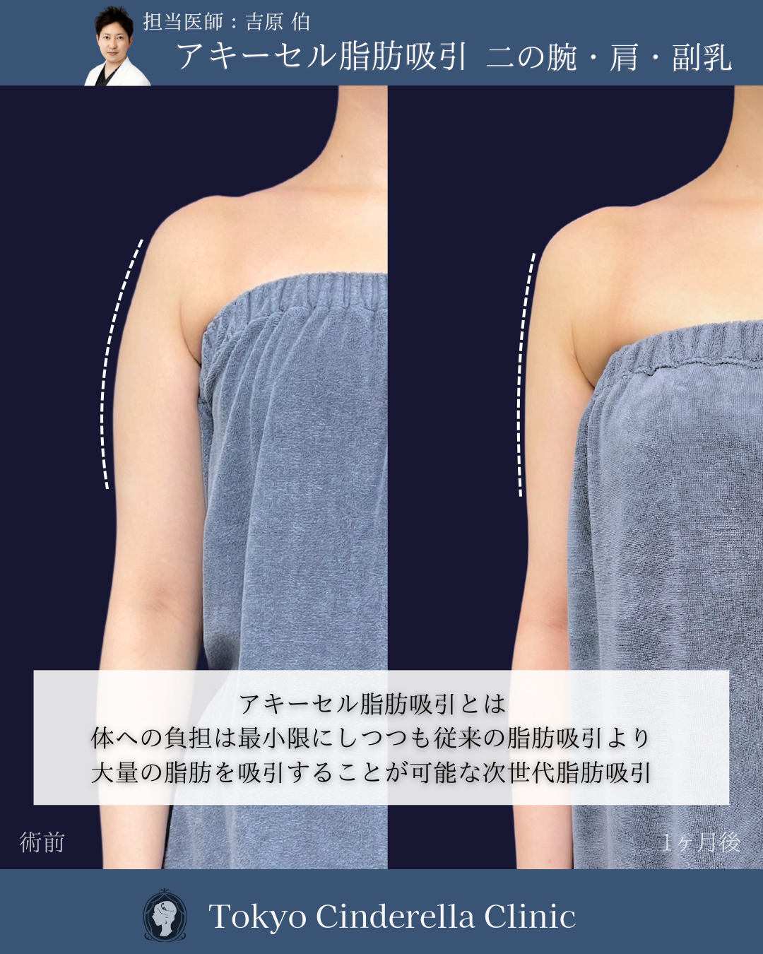新宿院で行ったお腹とウエストと腰のアキーセル脂肪吸引の名医の吉原伯医師の症例写真