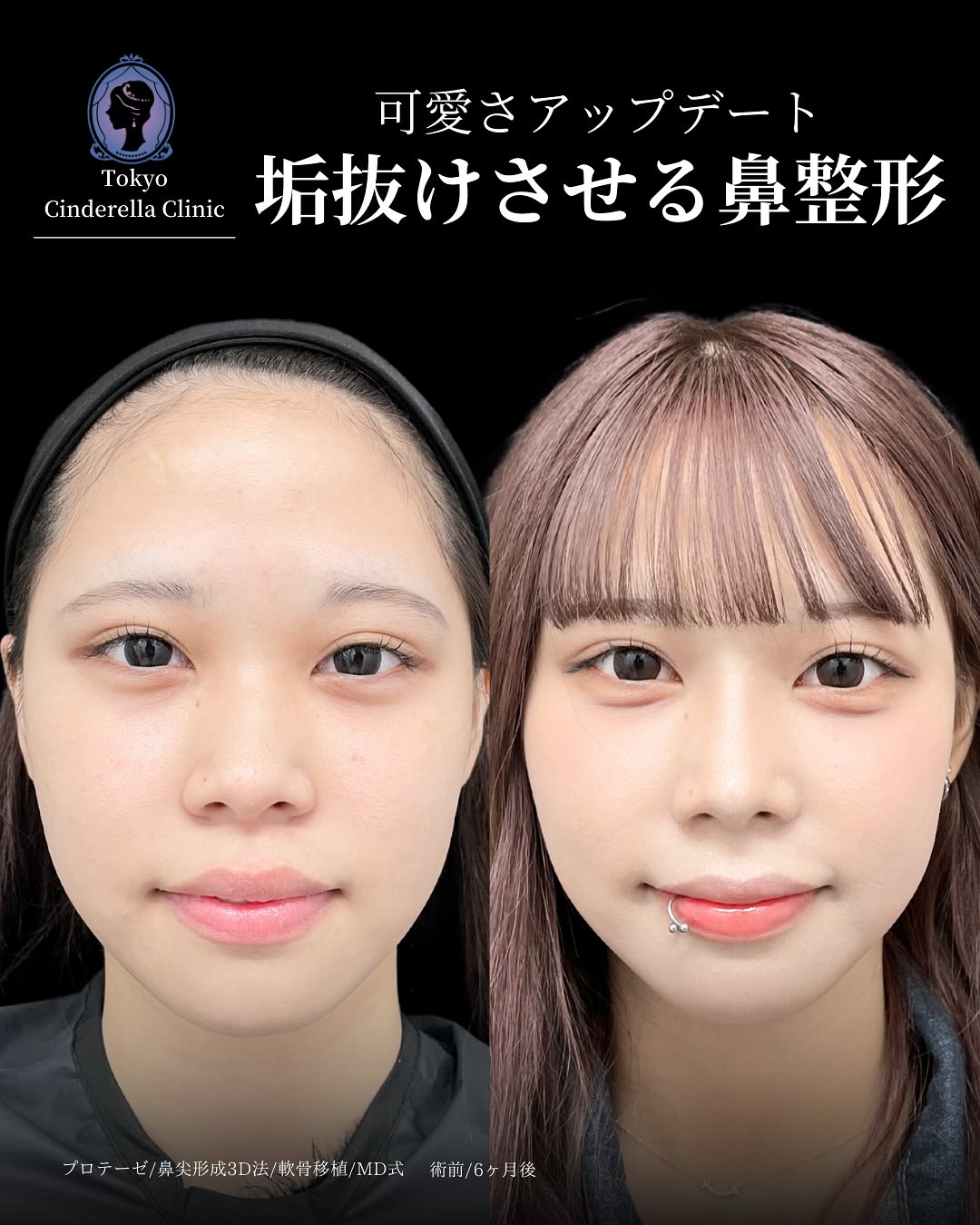 新宿院で行った鼻整形の名医の吉原伯医師のMD式のプロテーゼと鼻尖形成3D法と軟骨移植の症例写真
