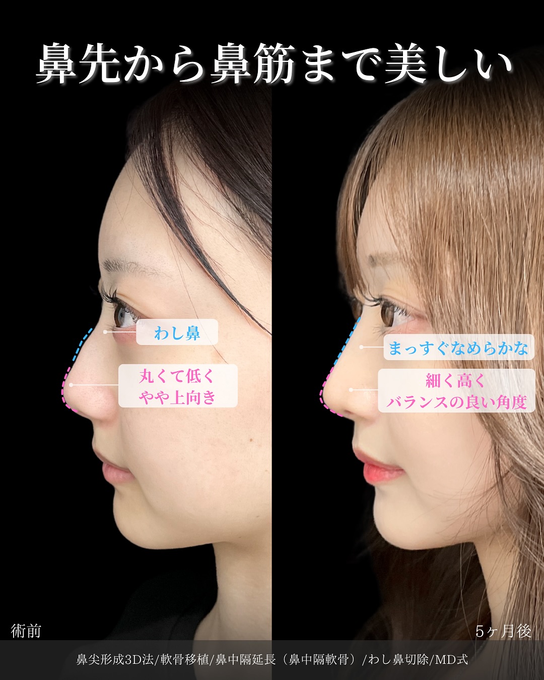 新宿院で行った鼻整形の名医の吉原伯医師のMD式の鼻尖形成3D法と軟骨移植と鼻中隔延長(鼻中隔軟骨)とわし鼻切除の症例写真