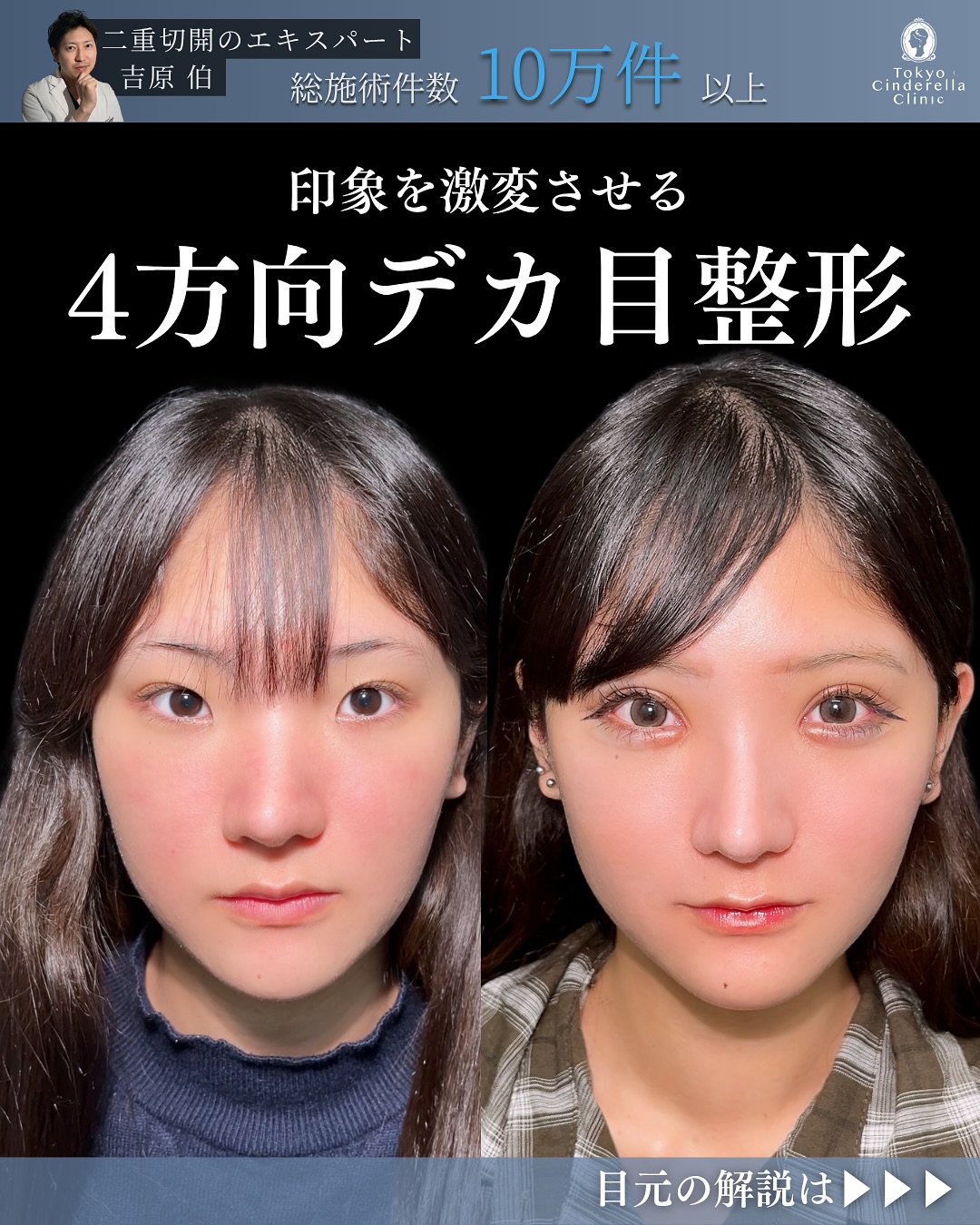 新宿院で行った二重整形で有名な吉原伯医師のMD式のたるみ取り併用全切開法二重術と眼瞼下垂手術と目頭切開と目尻切開とタレ目形成(結膜切開)と涙袋ヒアルの1ヶ月後の症例写真