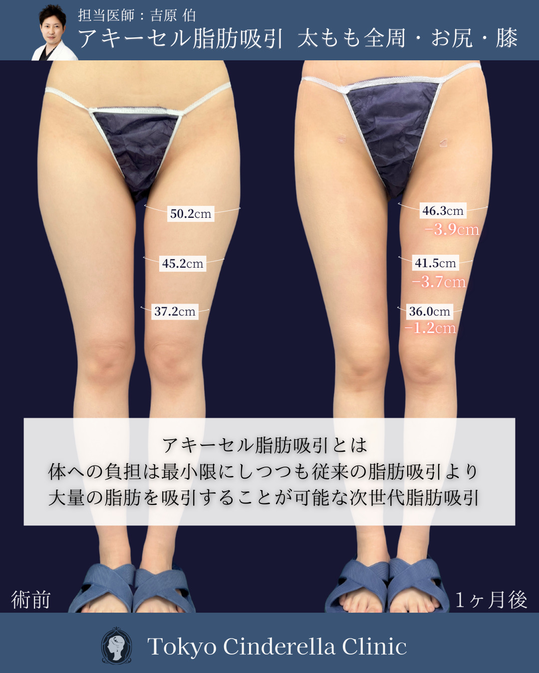 新宿院で行った鼻整形の名医の吉原伯医師のアキーセル脂肪吸引(太もも全周・お尻・膝)の症例写真