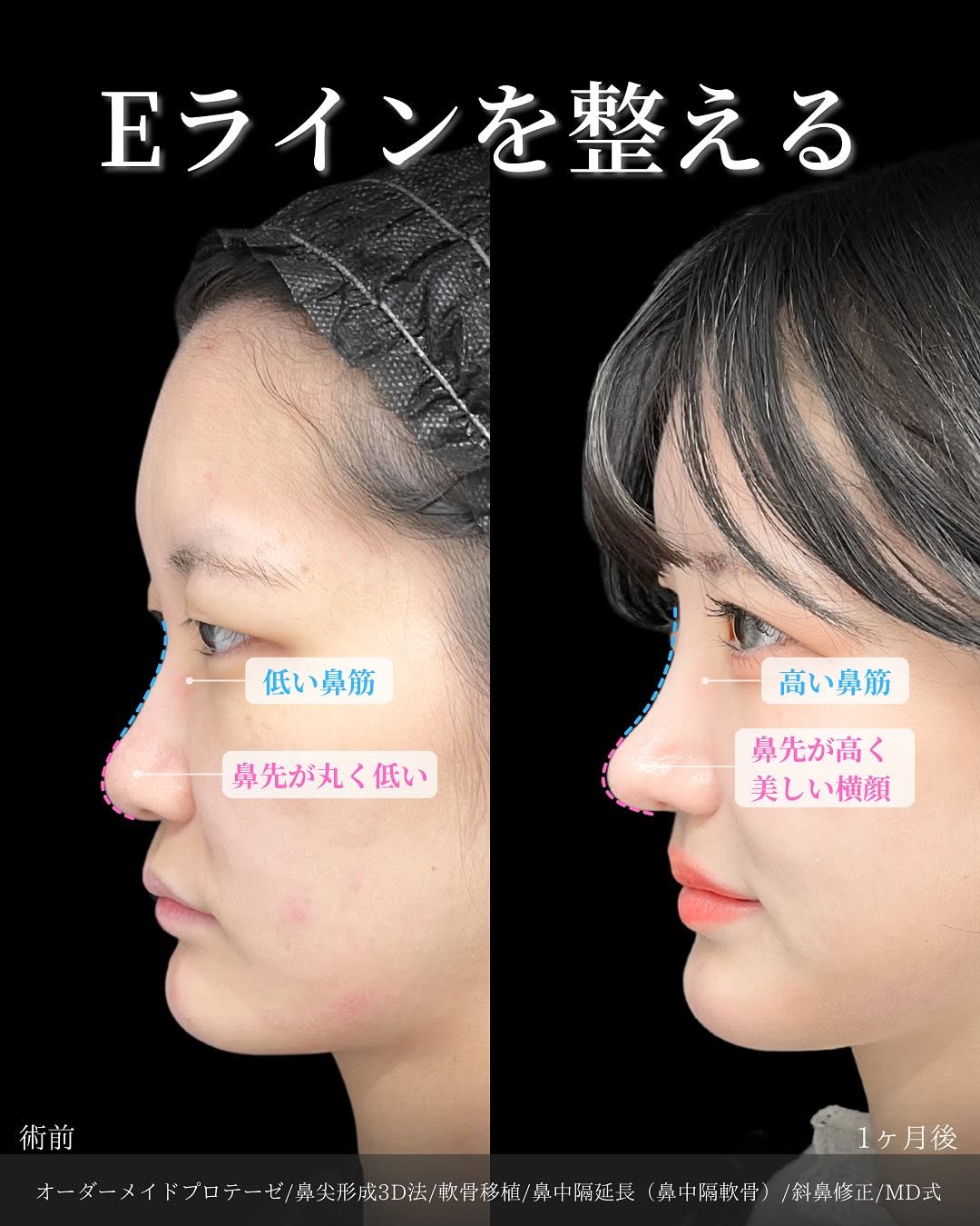 新宿院で行った鼻整形の名医の吉原伯医師のMD式のオーダーメイドプロテーゼと鼻尖形成3D法と軟骨移植と鼻中隔延長(鼻中隔軟骨)と斜鼻修正の症例写真