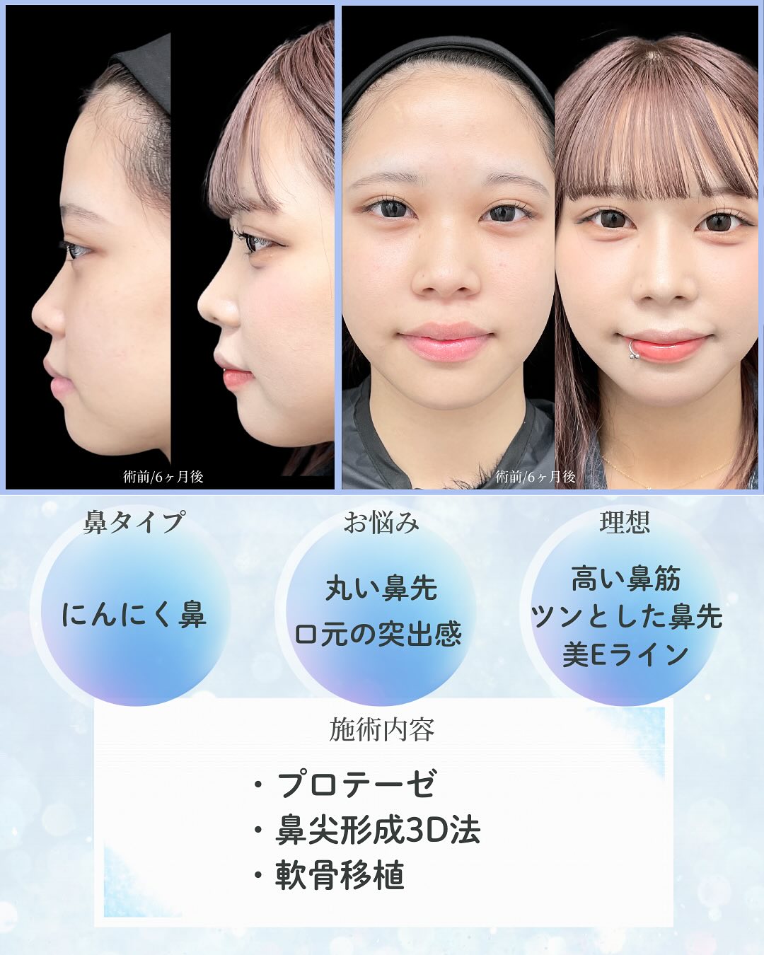 新宿院で行った鼻整形の名医の吉原伯医師のMD式のプロテーゼと鼻尖形成3D法と軟骨移植の症例写真