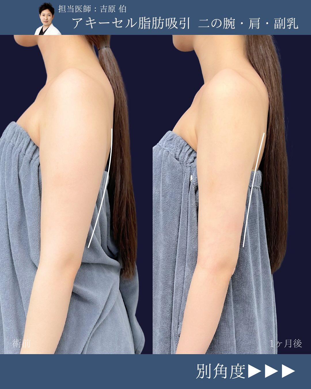 新宿院で行ったアキーセル脂肪吸引(二の腕・肩・副乳)の名医の吉原伯医師の症例写真
