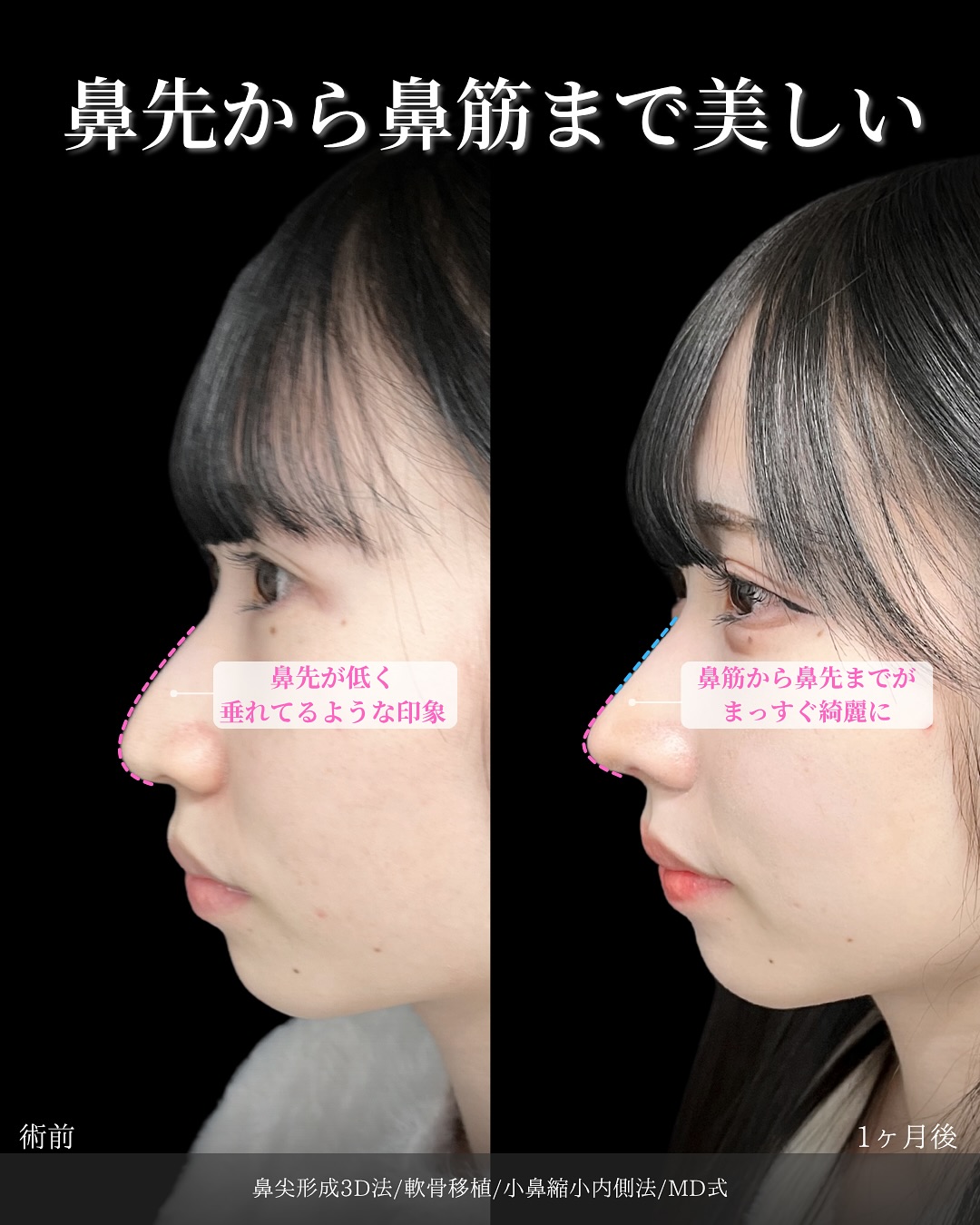 新宿院で行った鼻整形の名医の吉原伯医師のMD式の鼻尖形成3D法と軟骨移植と小鼻縮小内側法の症例写真
