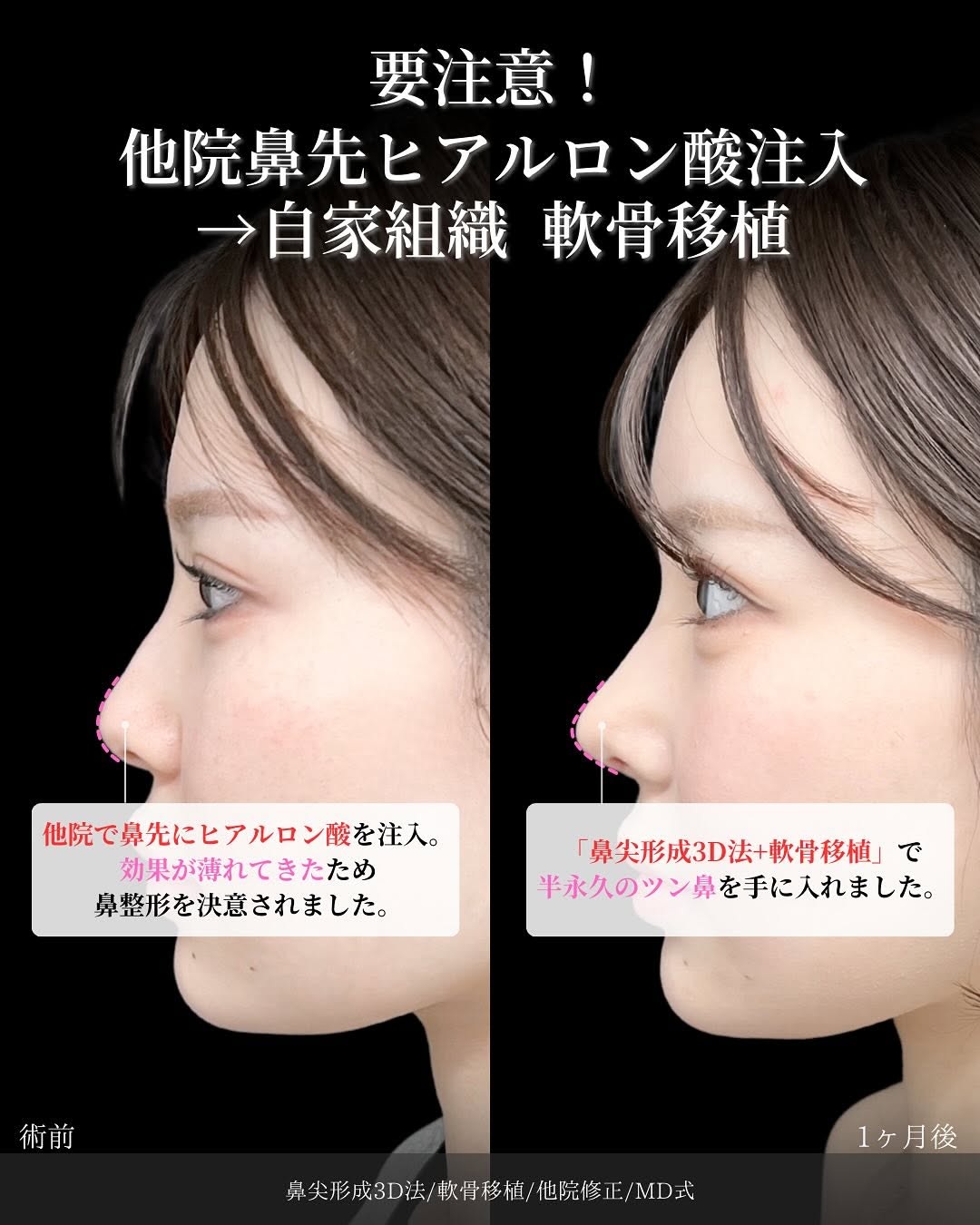 新宿院で行った鼻整形の名医の吉原伯医師のMD式の鼻尖形成3D法と軟骨移植と他院修正の症例写真
