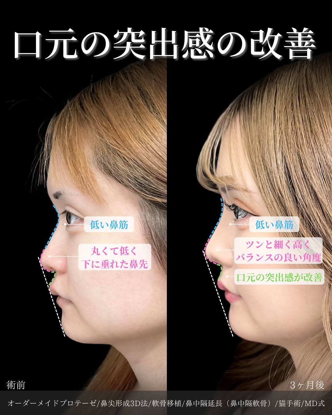 新宿院で行った鼻整形の名医の吉原伯医師のMD式のオーダーメイドプロテーゼと鼻尖形成3D法と軟骨移植と鼻中隔延長(鼻中隔軟骨)と猫手術の症例写真