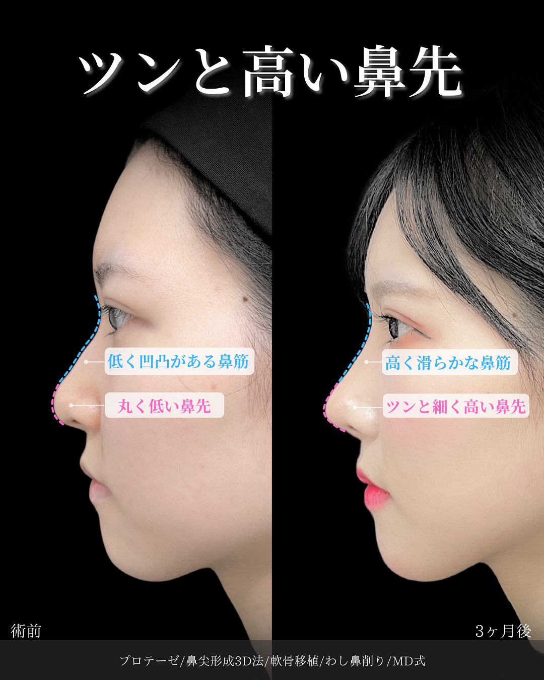 新宿院で行った鼻整形の名医の吉原伯医師のMD式のプロテーゼと鼻尖形成3D法と軟骨移植とわし鼻削りの症例写真