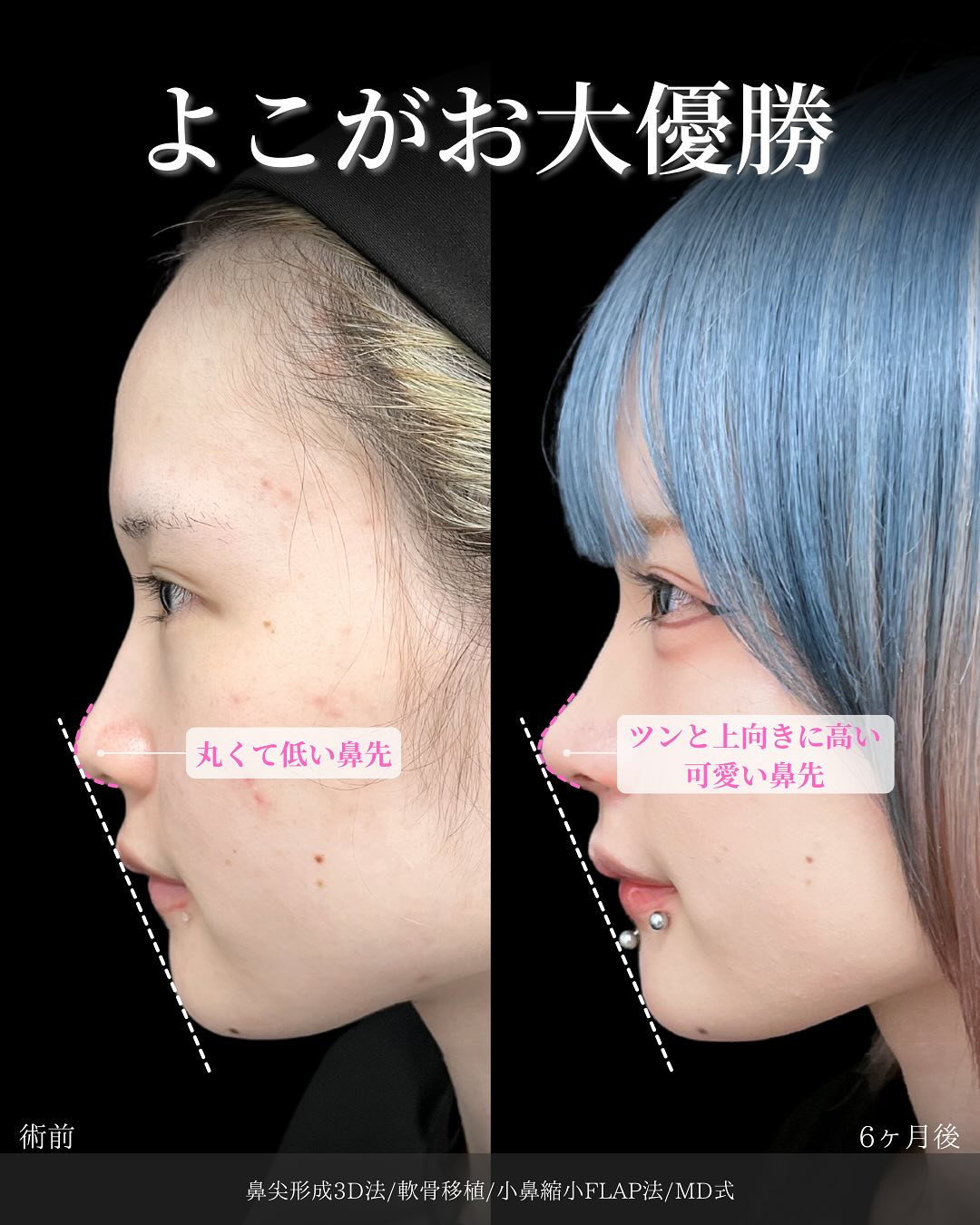新宿院で行った鼻整形の名医の吉原伯医師のMD式の鼻尖形成3D法と軟骨移植と小鼻縮小FLAP法の症例写真