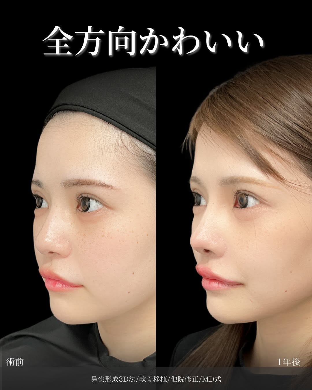 新宿院で行った鼻整形の名医の吉原伯医師のMD式の鼻尖形成3D法と軟骨移植と他院修正の症例写真