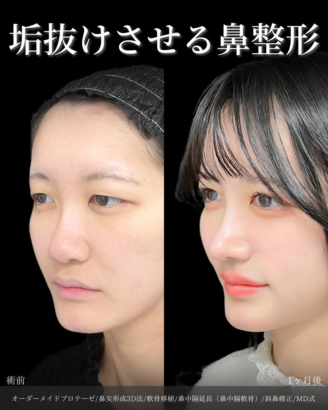 新宿院で行った鼻整形の名医の吉原伯医師のMD式のオーダーメイドプロテーゼと鼻尖形成3D法と軟骨移植と鼻中隔延長(鼻中隔軟骨)と斜鼻修正の症例写真
