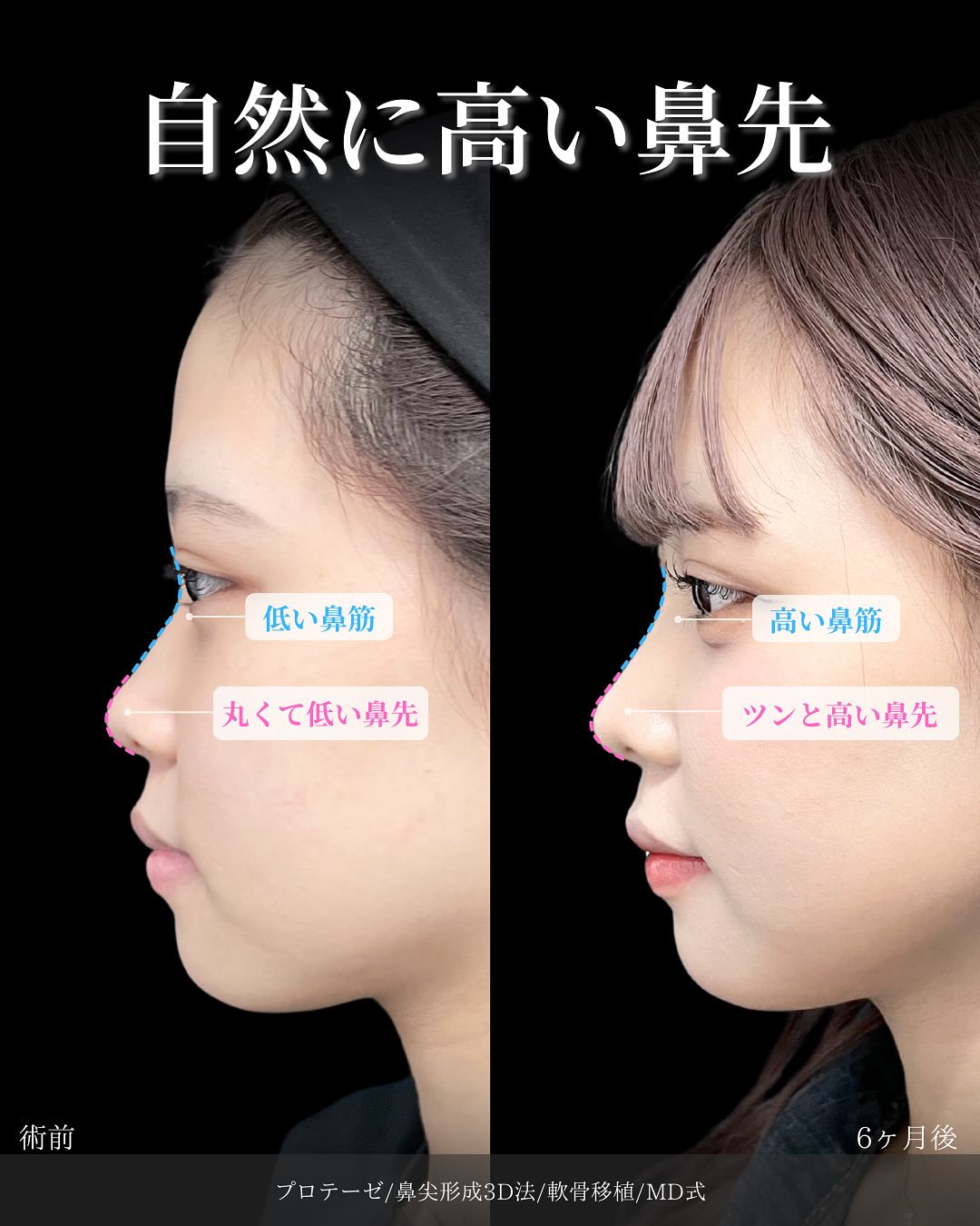 新宿院で行った鼻整形の名医の吉原伯医師のMD式のプロテーゼと鼻尖形成3D法と軟骨移植の症例写真