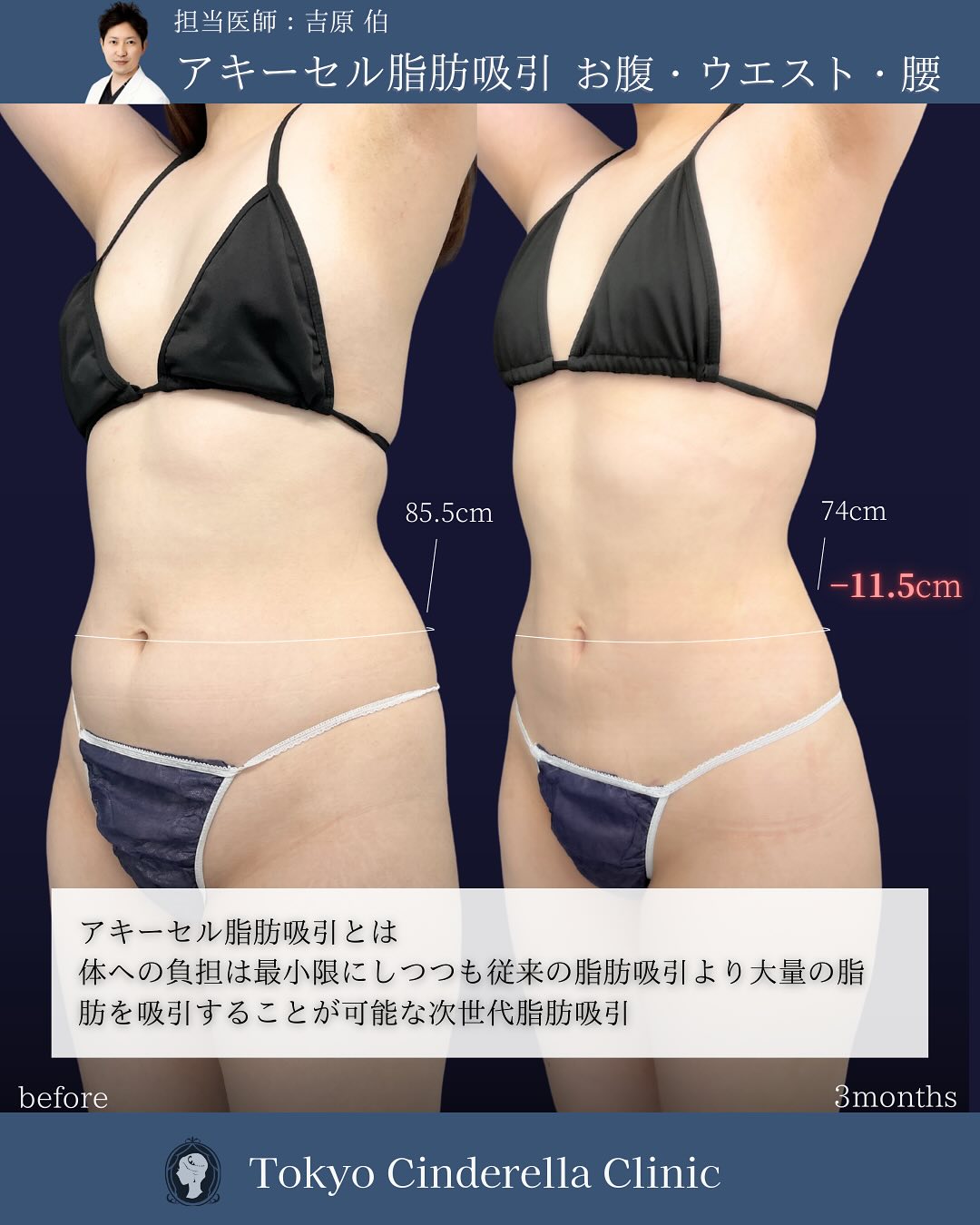 新宿院で行ったアキーセル脂肪吸引(お腹・ウエスト・腰)の名医の吉原伯医師の症例写真
