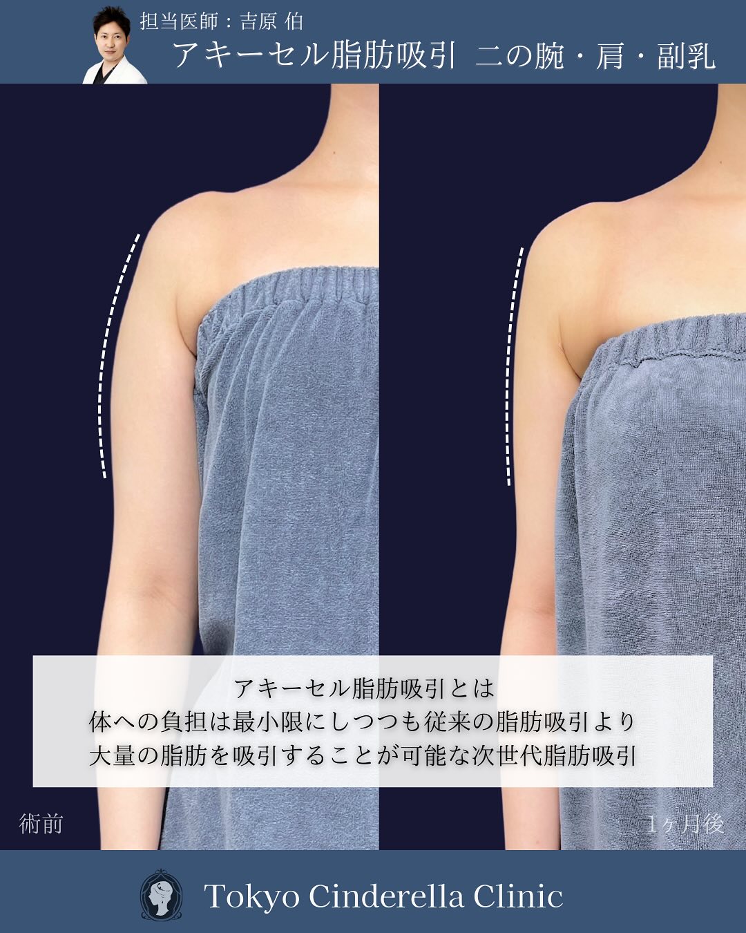 新宿院で行ったアキーセル脂肪吸引(二の腕・肩・副乳)の名医の吉原伯医師の症例写真