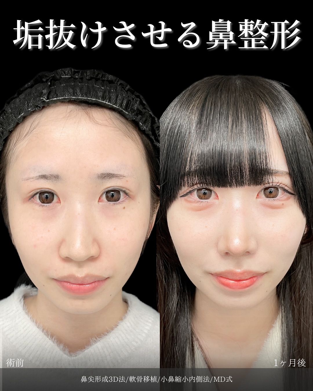 新宿院で行った鼻整形の名医の吉原伯医師のMD式の鼻尖形成3D法と軟骨移植と小鼻縮小内側法の症例写真