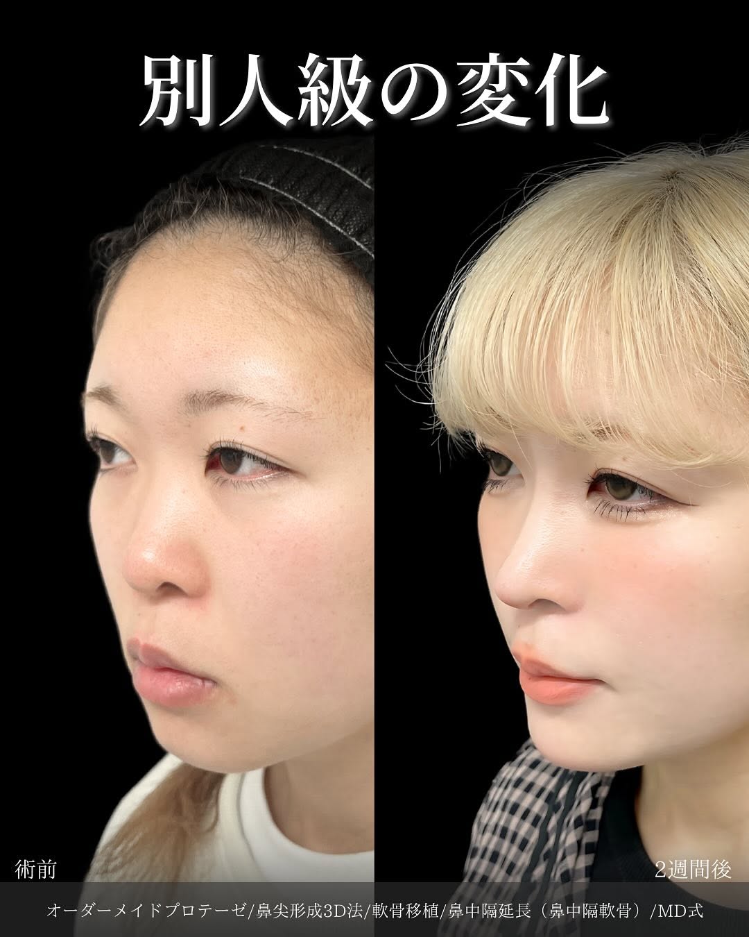 新宿院で行った鼻整形の名医の吉原伯医師のMD式のオーダーメイドプロテーゼと鼻尖形成3D法と軟骨移植と鼻中隔延長(鼻中隔軟骨)の症例写真
