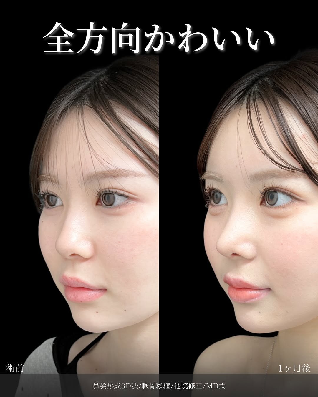 新宿院で行った鼻整形の名医の吉原伯医師のMD式の鼻尖形成3D法と軟骨移植と他院修正の症例写真
