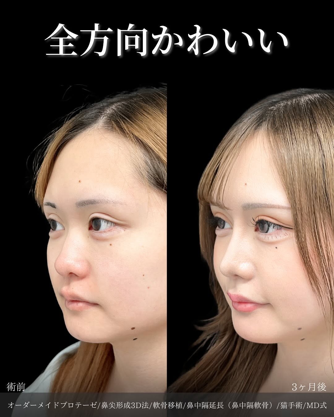新宿院で行った鼻整形の名医の吉原伯医師のMD式のオーダーメイドプロテーゼと鼻尖形成3D法と軟骨移植と鼻中隔延長(鼻中隔軟骨)と猫手術の症例写真