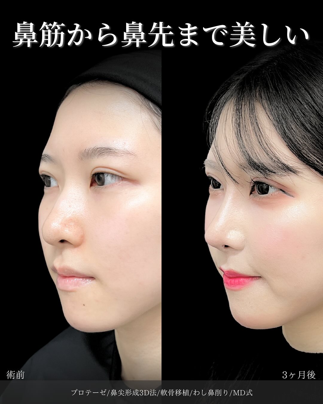 新宿院で行った鼻整形の名医の吉原伯医師のMD式のプロテーゼと鼻尖形成3D法と軟骨移植とわし鼻削りの症例写真