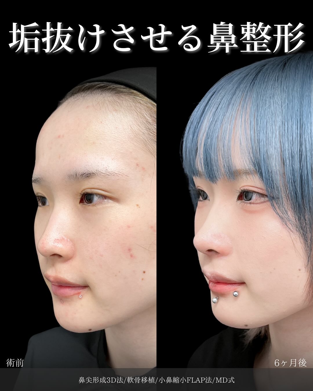 新宿院で行った鼻整形の名医の吉原伯医師のMD式の鼻尖形成3D法と軟骨移植と小鼻縮小FLAP法の症例写真