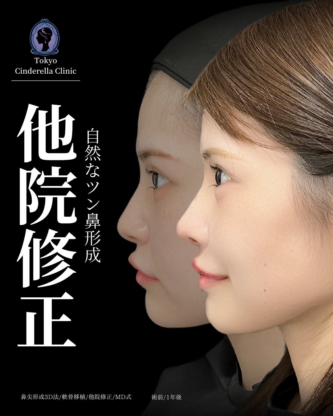 新宿院で行った鼻整形の名医の吉原伯医師のMD式の鼻尖形成3D法と軟骨移植と他院修正の症例写真