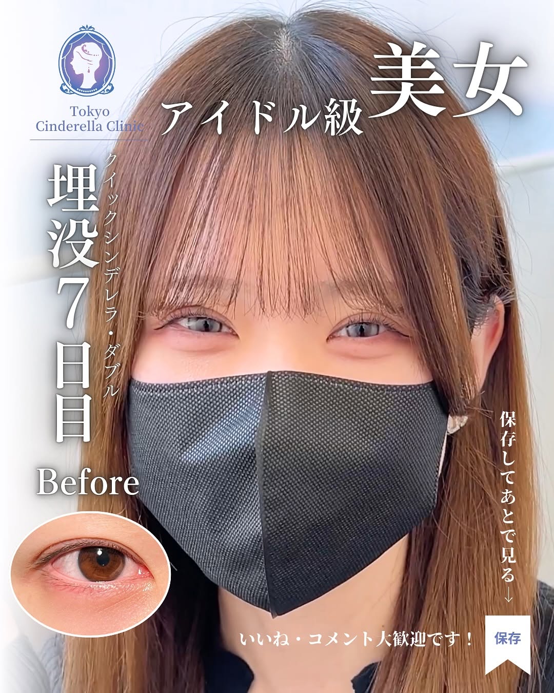 大宮院で行った二重整形の竹田昌平医師の症例写真