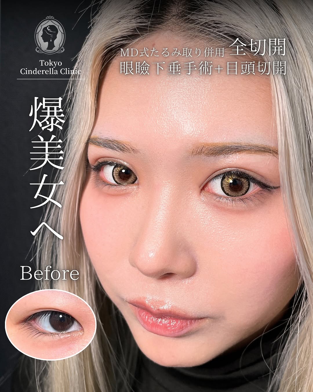 大宮院で行った二重整形の竹田昌平医師の症例写真
