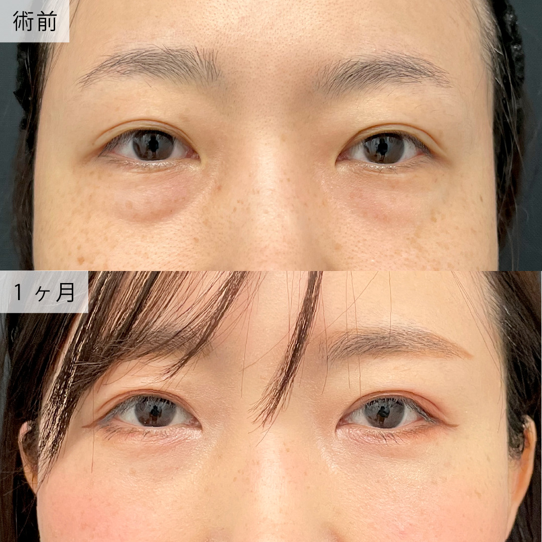 新宿院で行った裏ハムラ法の名医の吉原伯医師の症例写真
