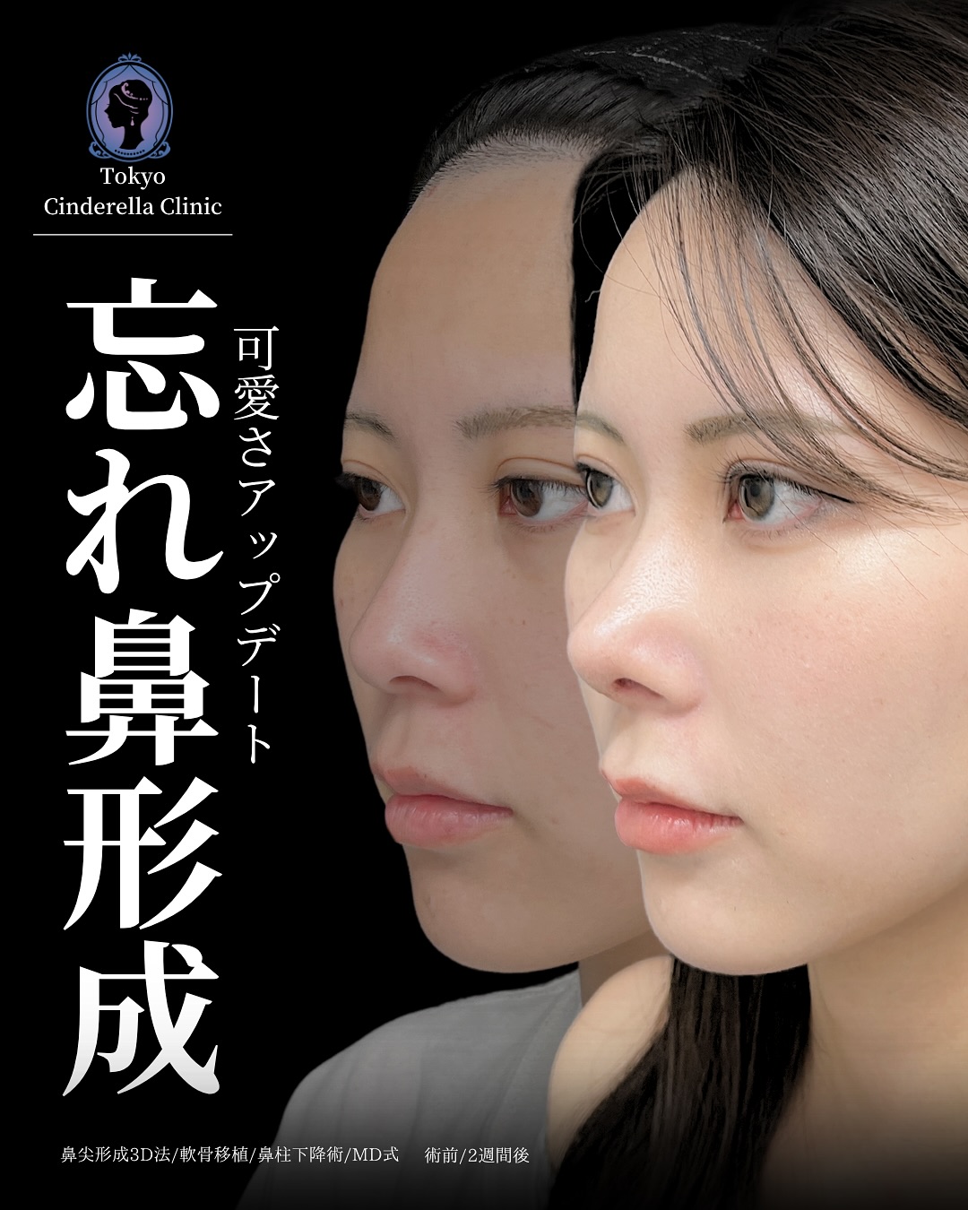 新宿院で行った鼻整形の名医の吉原伯医師のMD式のたるみ取り併用全切開法二重術と眼瞼下垂手術と目頭切開と他院修正の症例写真