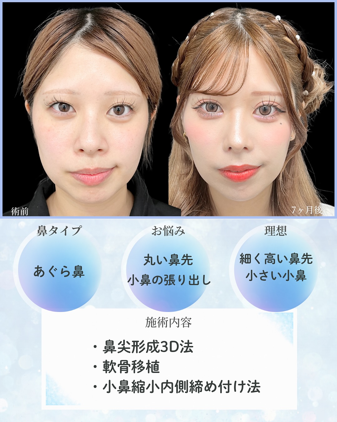 新宿院で行った鼻整形の名医の吉原伯医師のMD式の鼻尖形成3D法と軟骨移植と小鼻縮小内側締め付け法と韓国式自然癒着法6点の症例写真