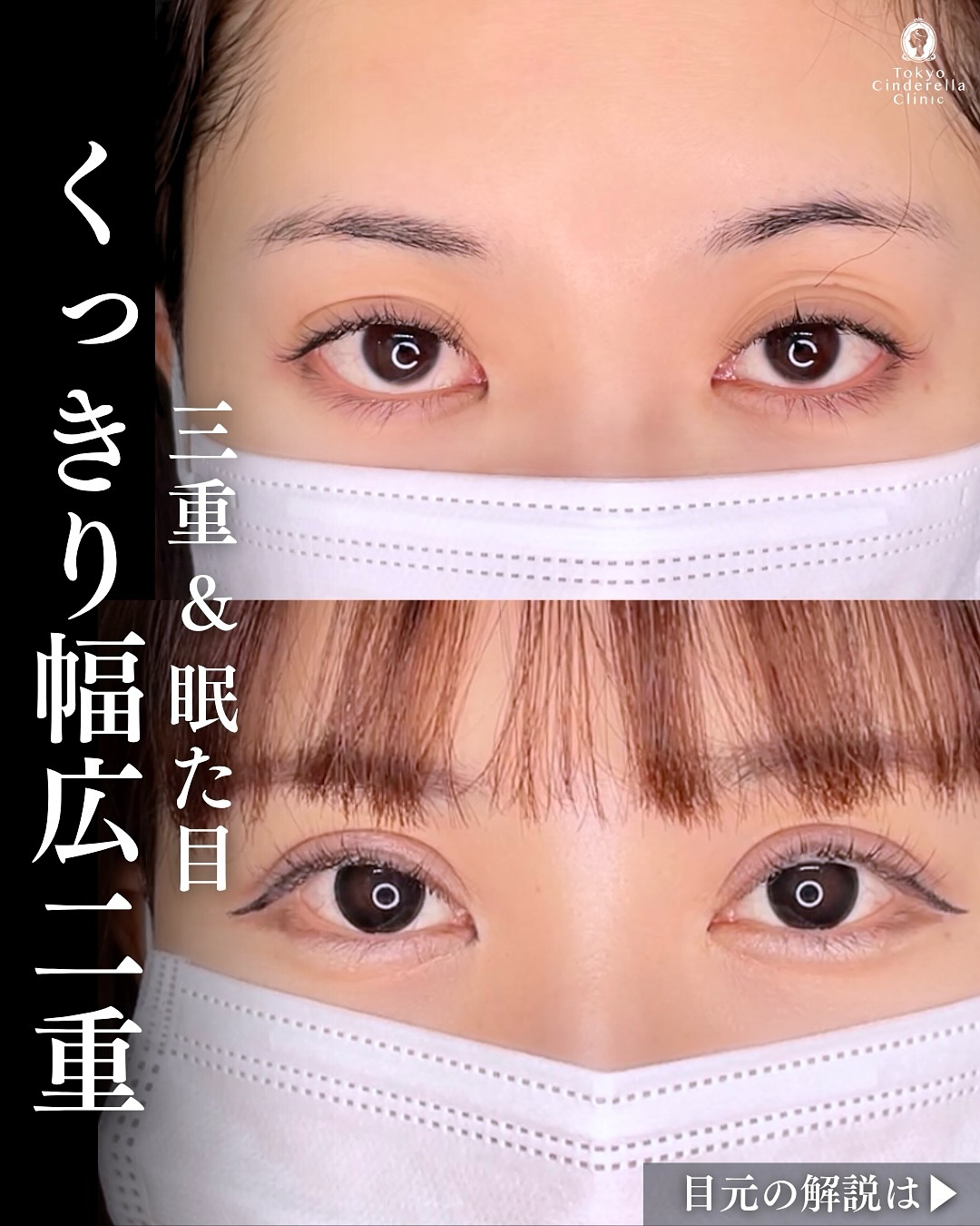 新宿院で行った二重整形で有名な吉原伯医師のMD式のたるみ取り併用全切開法二重術と眼瞼下垂手術の6ヶ月後の症例写真