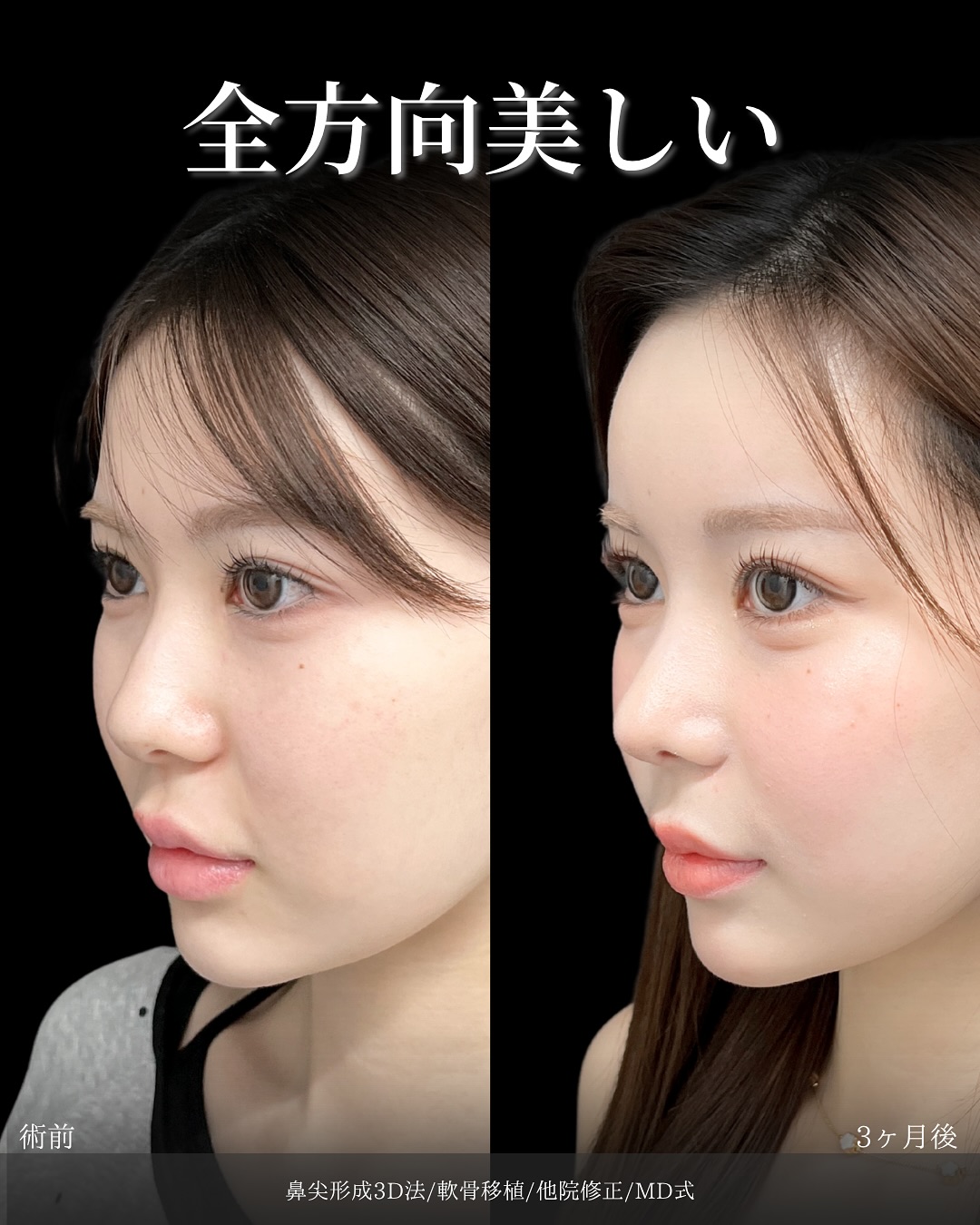 新宿院で行った鼻整形の名医の吉原伯医師のMD式の鼻尖形成3D法と軟骨移植と他院修正の症例写真
