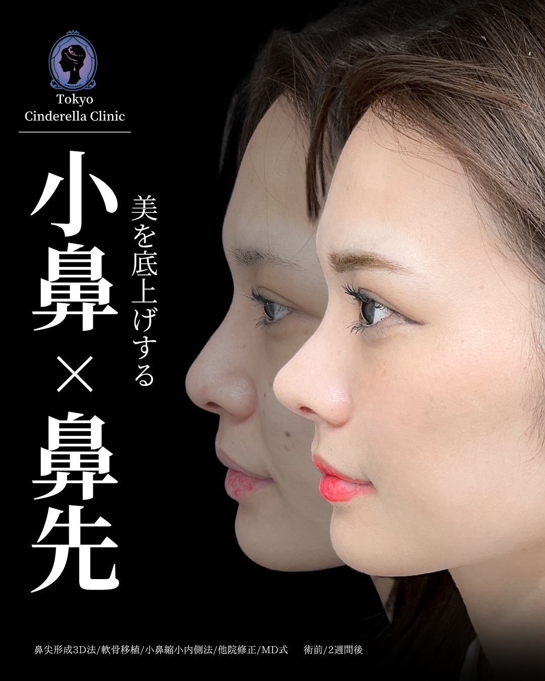 新宿院で行った鼻整形の名医の吉原伯医師のMD式の鼻尖形成3D法と軟骨移植と小鼻縮小内側法と他院修正の症例写真