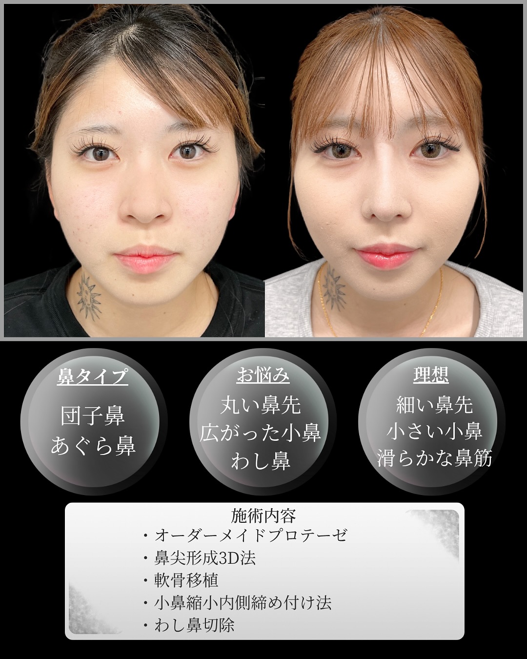 新宿院で行った鼻整形の名医の吉原伯医師のMD式のオーダーメイドプロテーゼと鼻尖形成3D法と軟骨移植と小鼻縮小内側締め付け法とわし鼻切除の症例写真