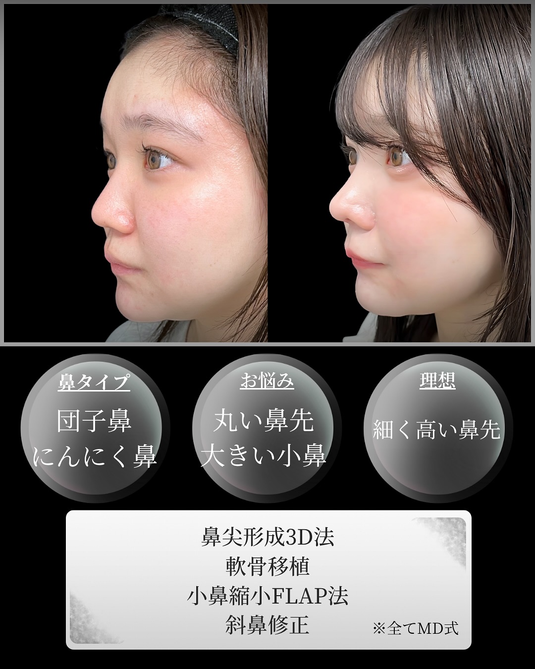 新宿院で行った鼻整形の名医の吉原伯医師のMD式の鼻尖形成3D法と軟骨移植と斜鼻修正と小鼻縮小FLAP法の症例写真