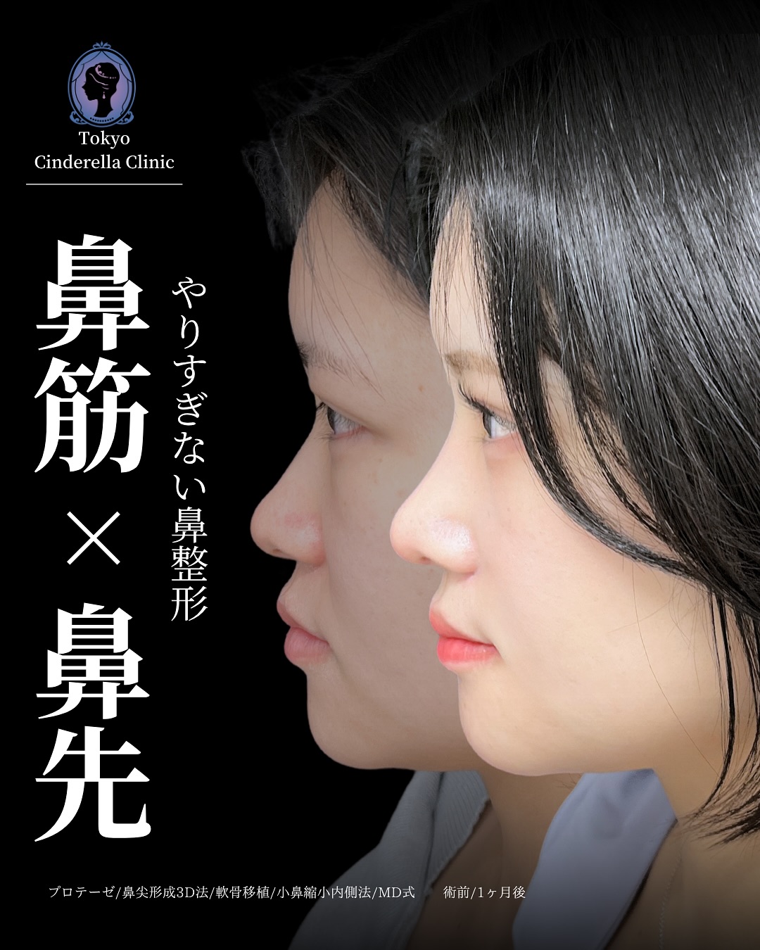 新宿院で行った鼻整形の名医の吉原伯医師のMD式のプロテーゼと鼻尖形成3D法と軟骨移植と小鼻縮小内側法の症例写真