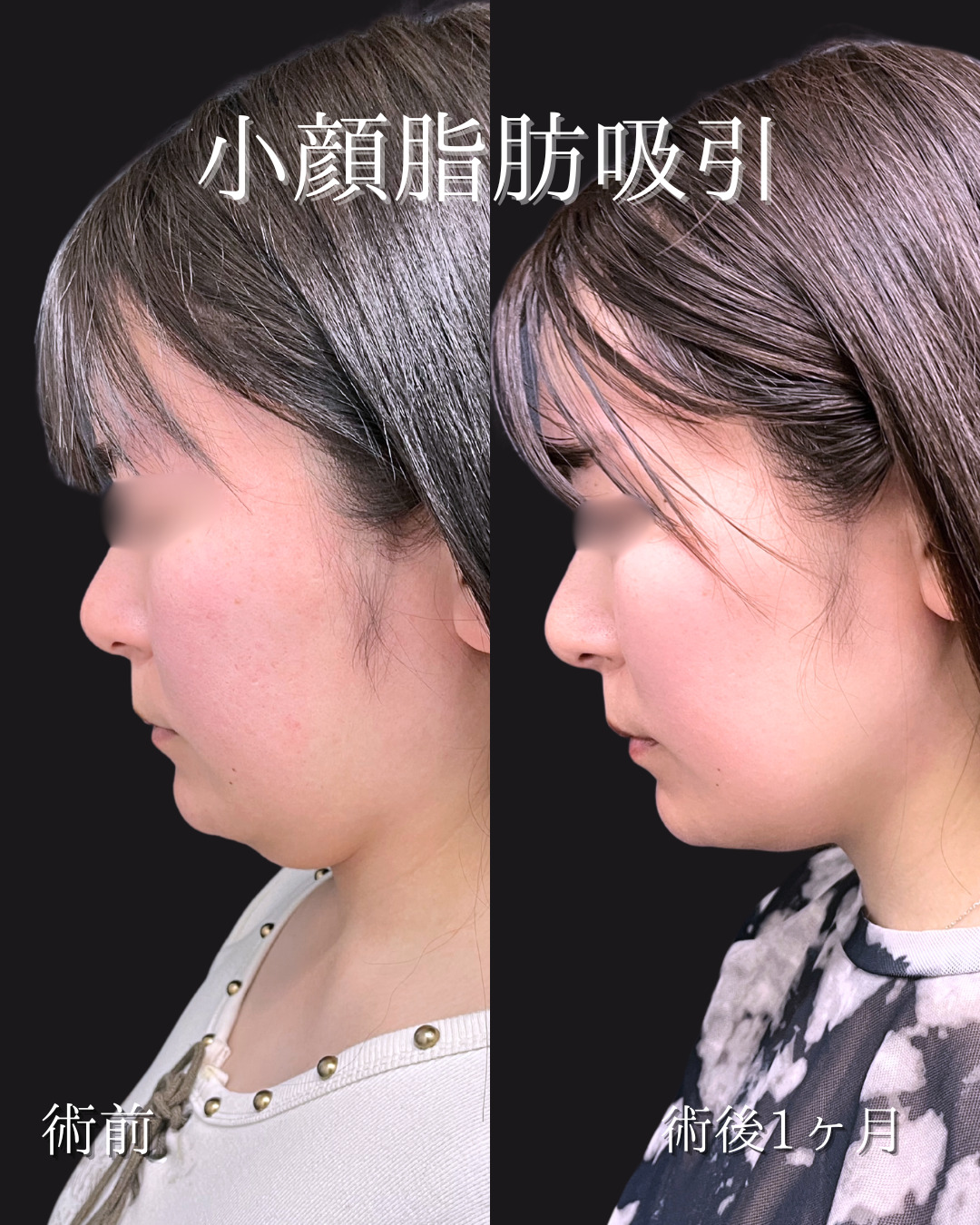 池袋院で行った小顔整形の石井達也医師の症例写真