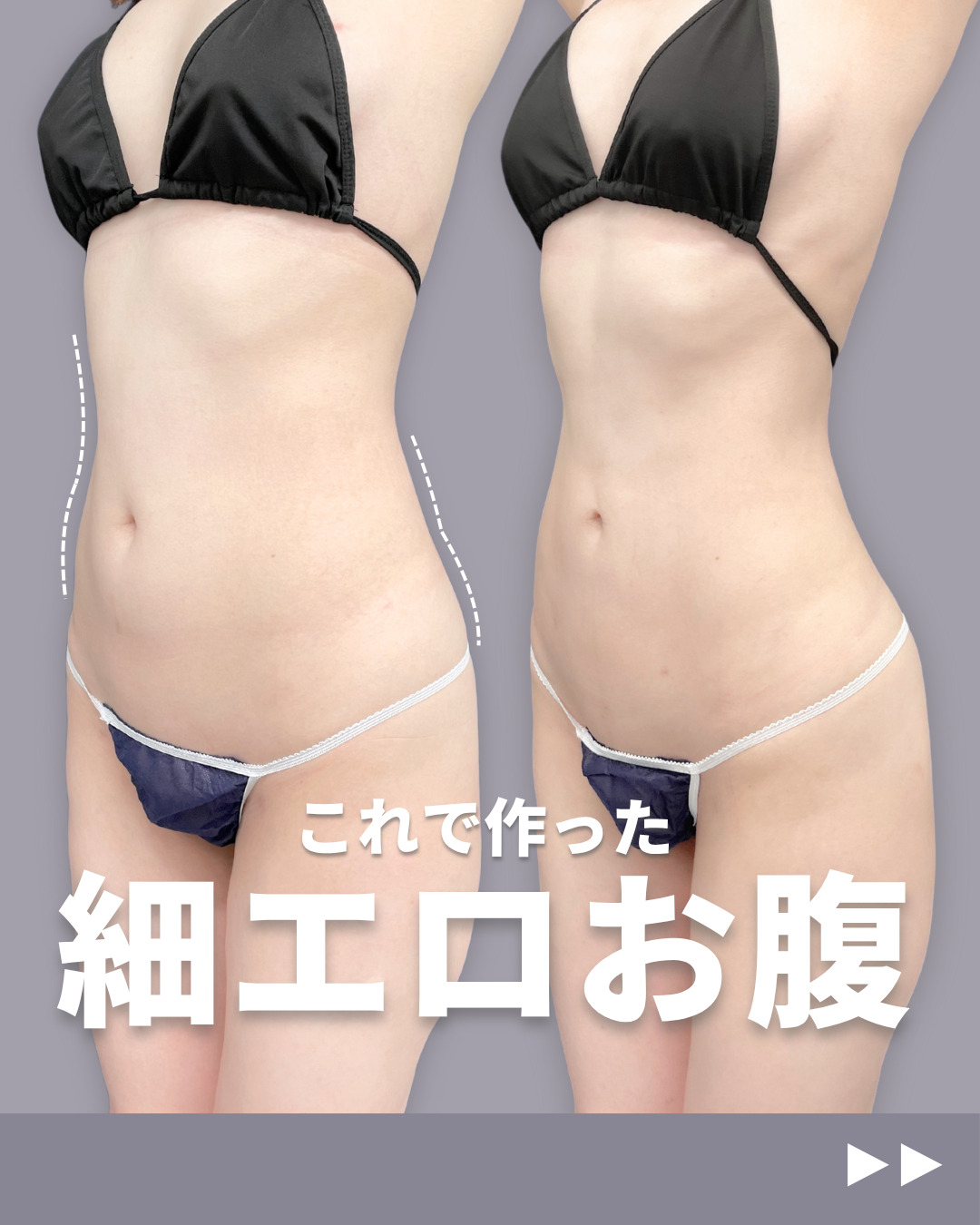 新宿院で行ったシンデレラ脂肪吸引(お腹・ウエスト・腰)の名医の吉原伯医師の症例写真