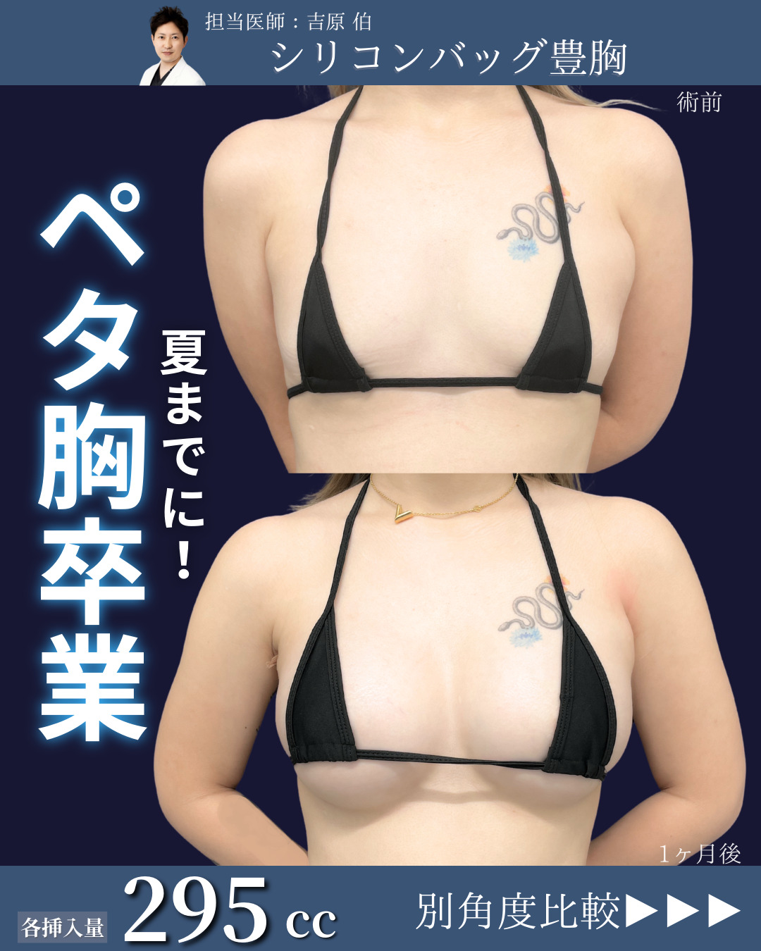 新宿院で行ったシリコンバッグ豊胸(Motivaエルゴノミックス2)の名医の吉原伯医師の症例写真