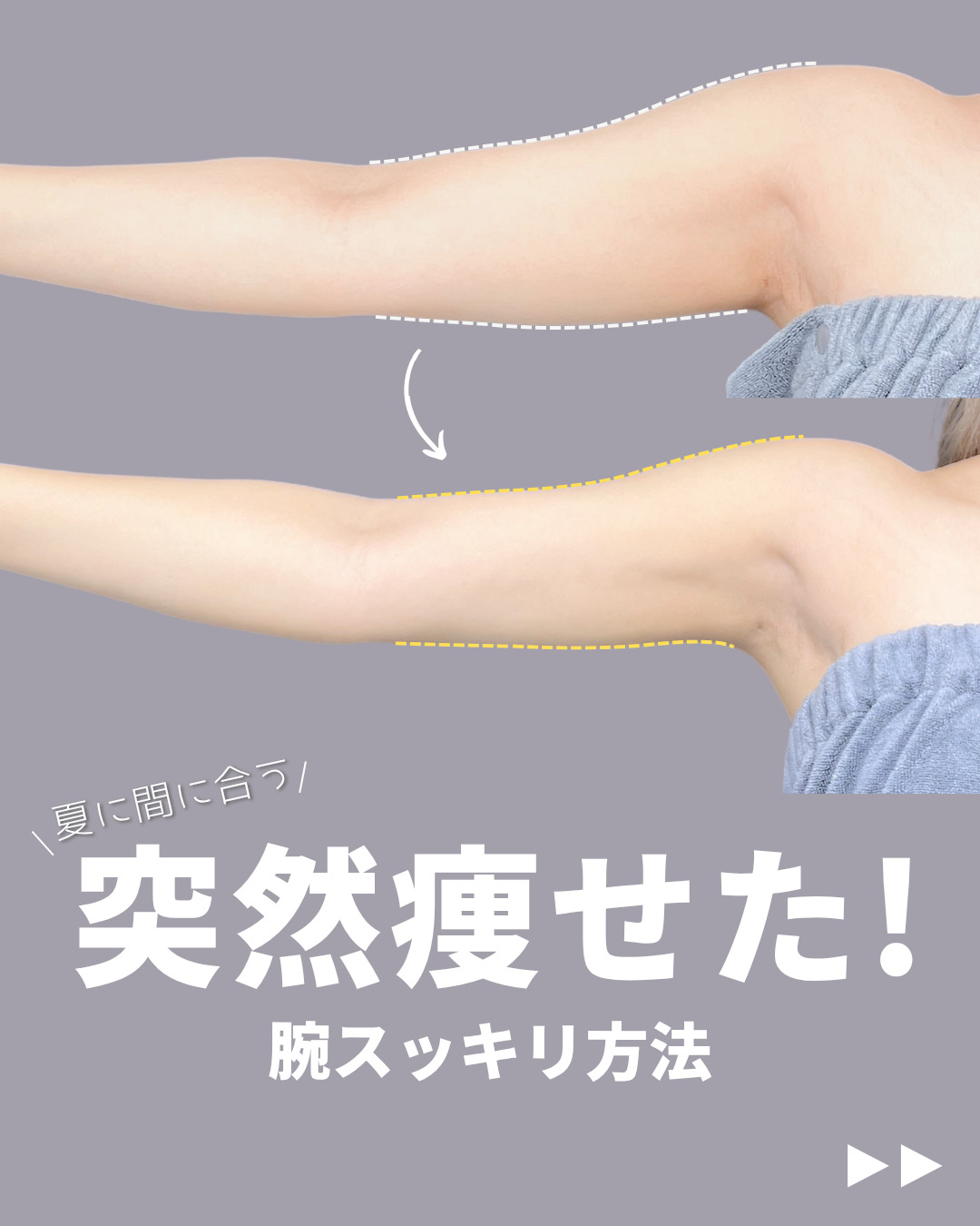 新宿院で行ったアキーセル脂肪吸引(二の腕・肩)の名医の吉原伯医師の症例写真
