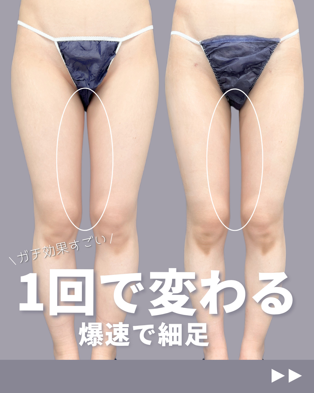 新宿院で行ったアキーセル脂肪吸引(太もも全周・お尻・膝)の名医の吉原伯医師の症例写真