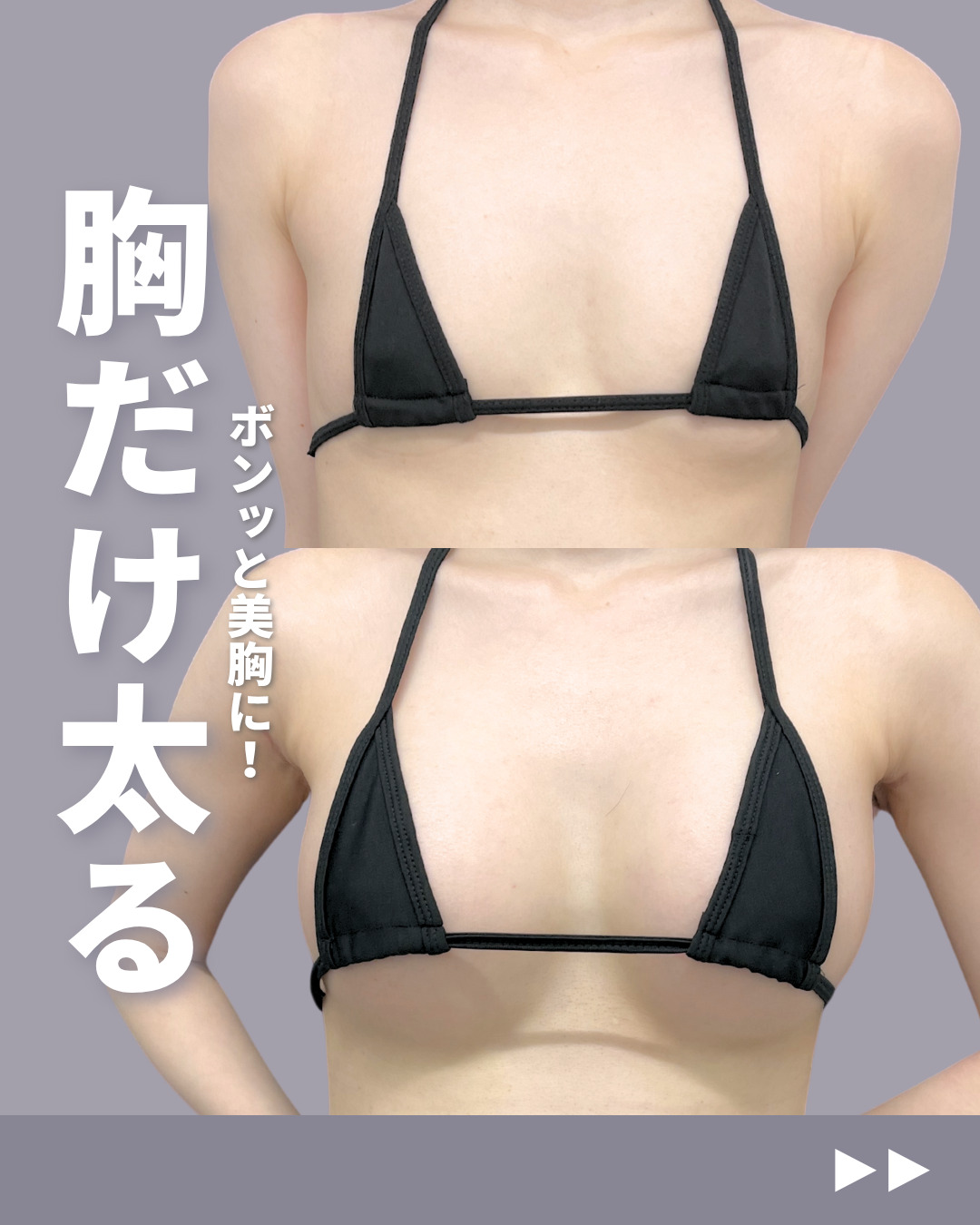 新宿院で行ったシリコンバッグ豊胸(セレフォーム)と修正軽度の名医の吉原伯医師の症例写真