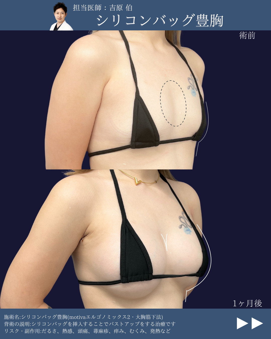 新宿院で行ったシリコンバッグ豊胸(Motivaエルゴノミックス2)の名医の吉原伯医師の症例写真
