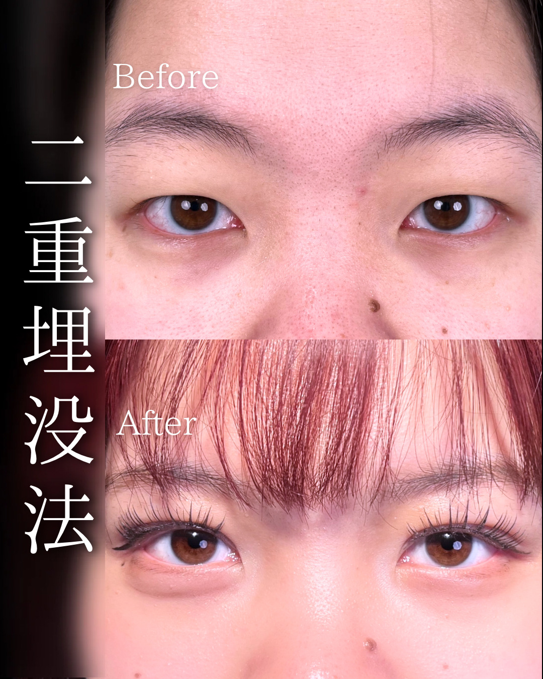 池袋院で行った二重整形の石井達也医師の症例写真