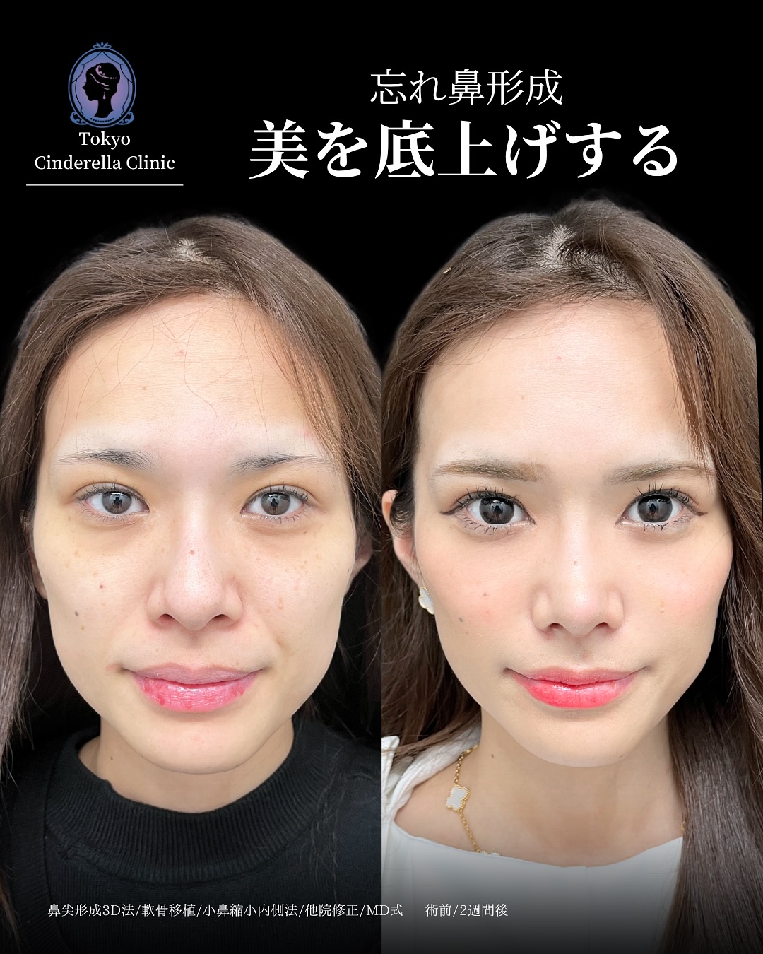 新宿院で行った鼻整形の名医の吉原伯医師のMD式の鼻尖形成3D法と軟骨移植と小鼻縮小内側法と他院修正の症例写真