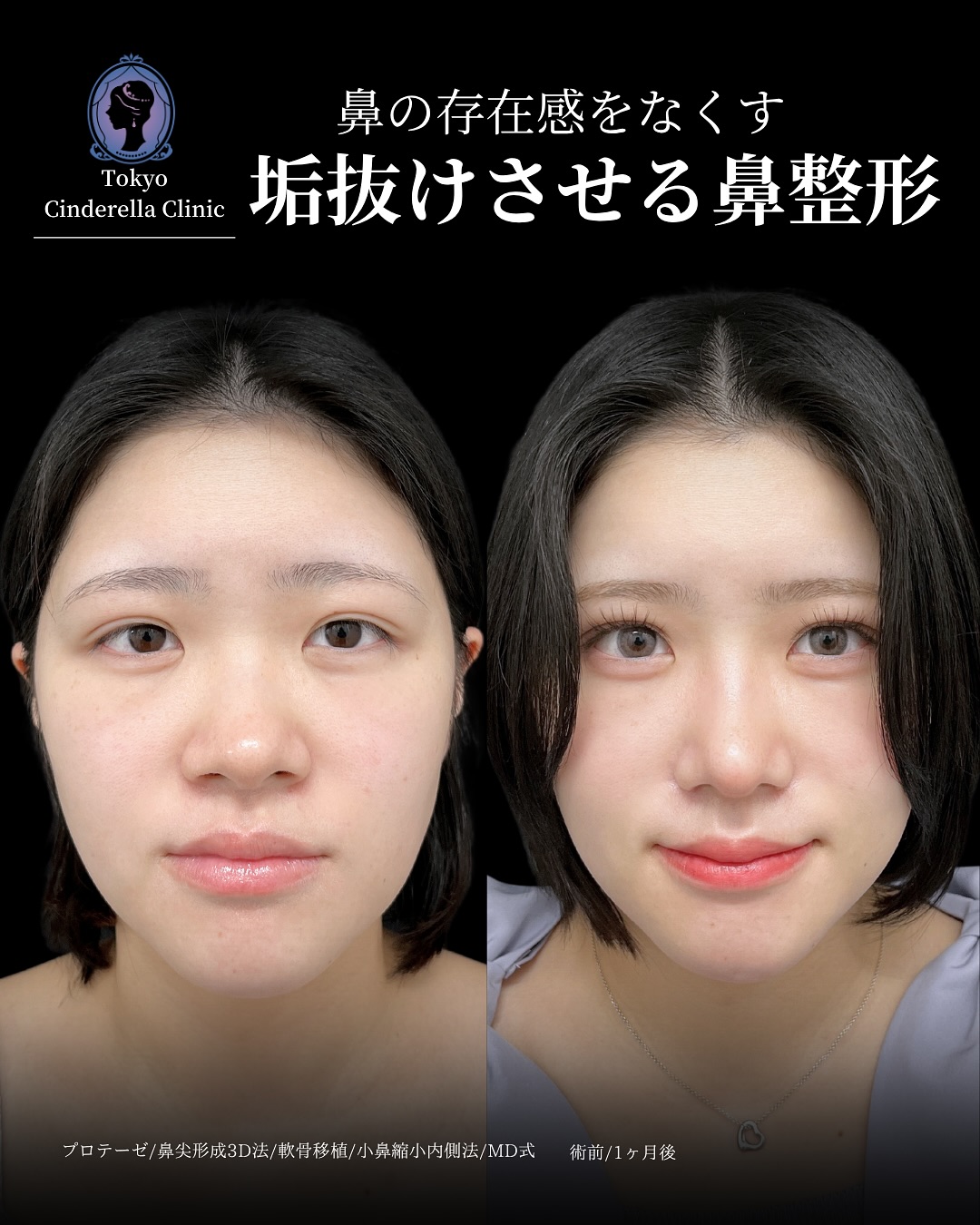 新宿院で行った鼻整形の名医の吉原伯医師のMD式のプロテーゼと鼻尖形成3D法と軟骨移植と小鼻縮小内側法の症例写真