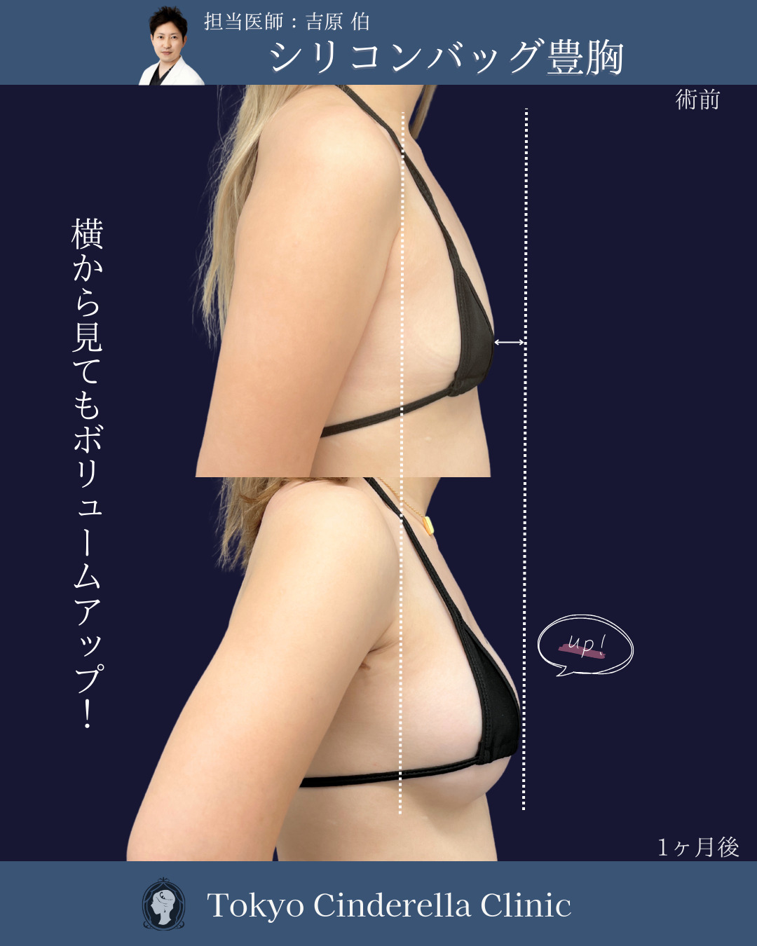 新宿院で行ったシリコンバッグ豊胸(Motivaエルゴノミックス2)の名医の吉原伯医師の症例写真