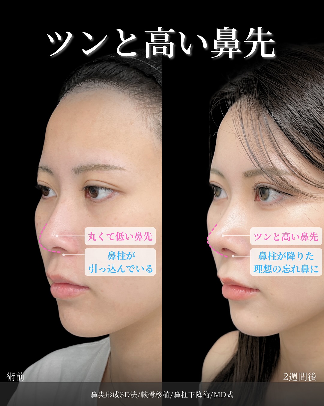 新宿院で行った鼻整形の名医の吉原伯医師のMD式のたるみ取り併用全切開法二重術と眼瞼下垂手術と目頭切開と他院修正の症例写真