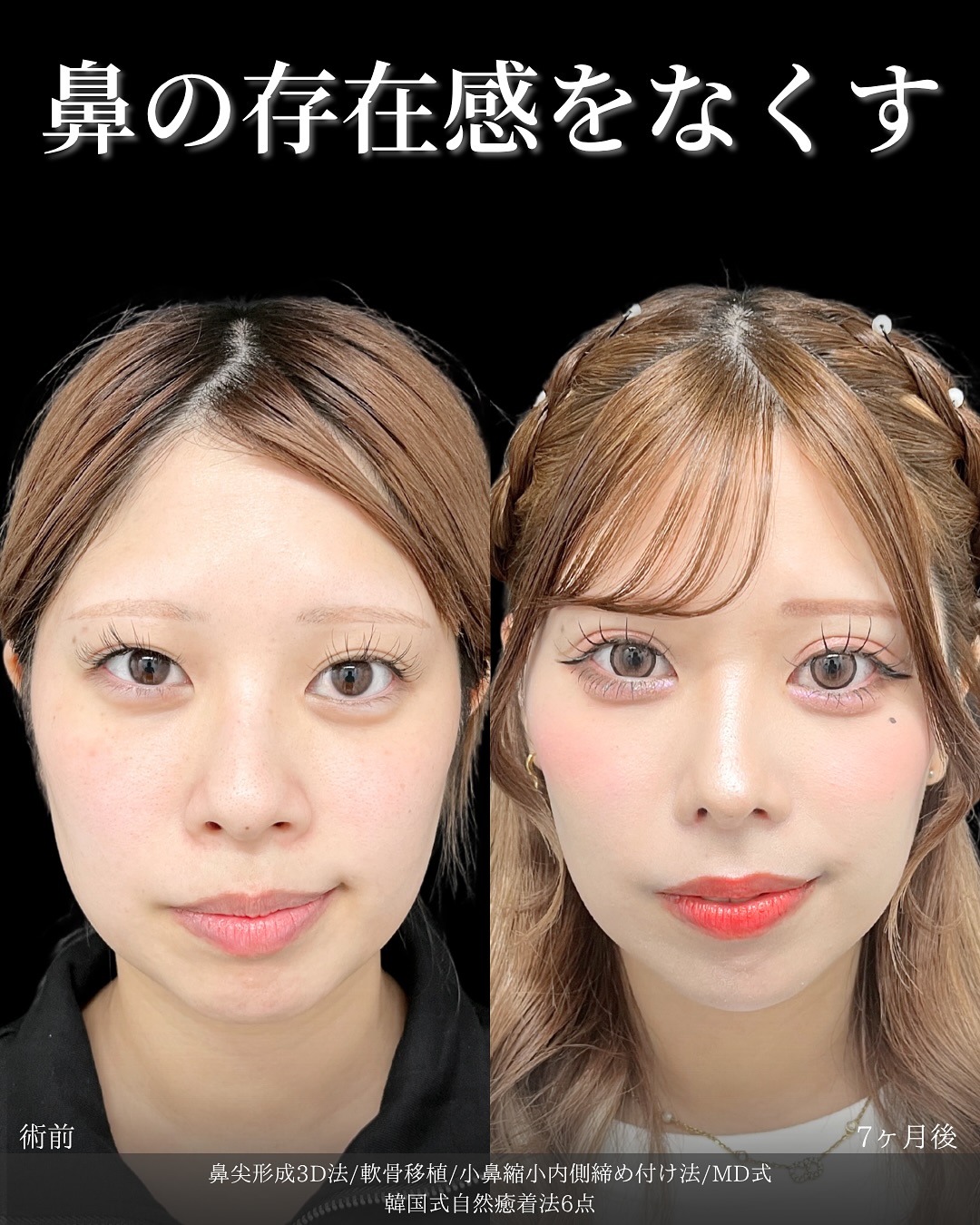 新宿院で行った鼻整形の名医の吉原伯医師のMD式の鼻尖形成3D法と軟骨移植と小鼻縮小内側締め付け法と韓国式自然癒着法6点の症例写真