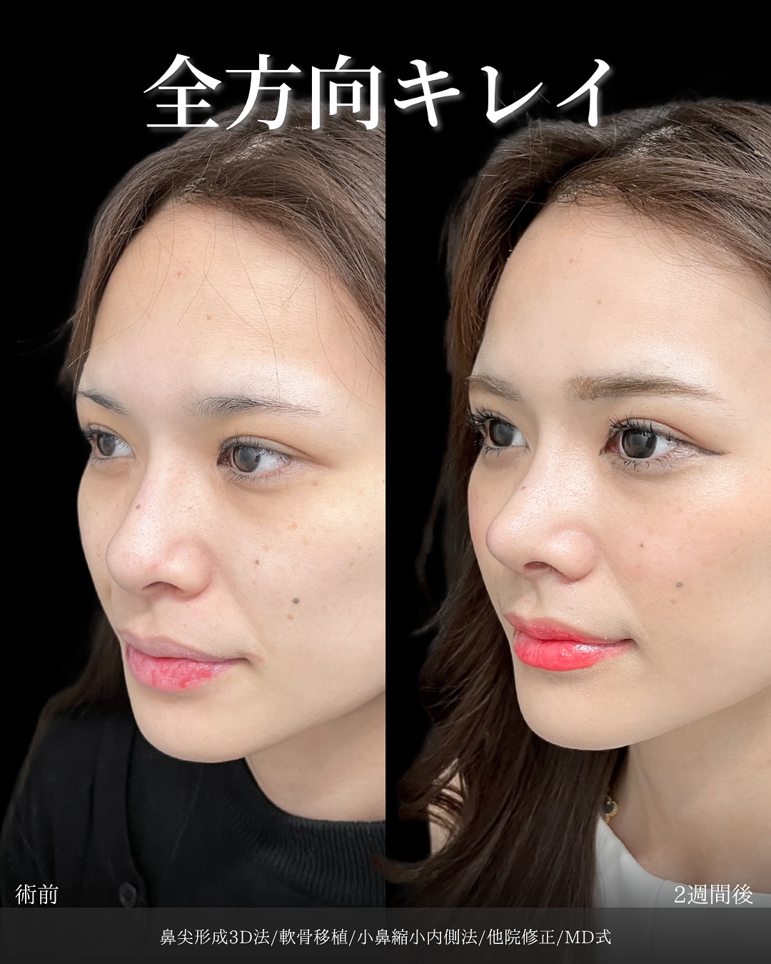 新宿院で行った鼻整形の名医の吉原伯医師のMD式の鼻尖形成3D法と軟骨移植と小鼻縮小内側法と他院修正の症例写真
